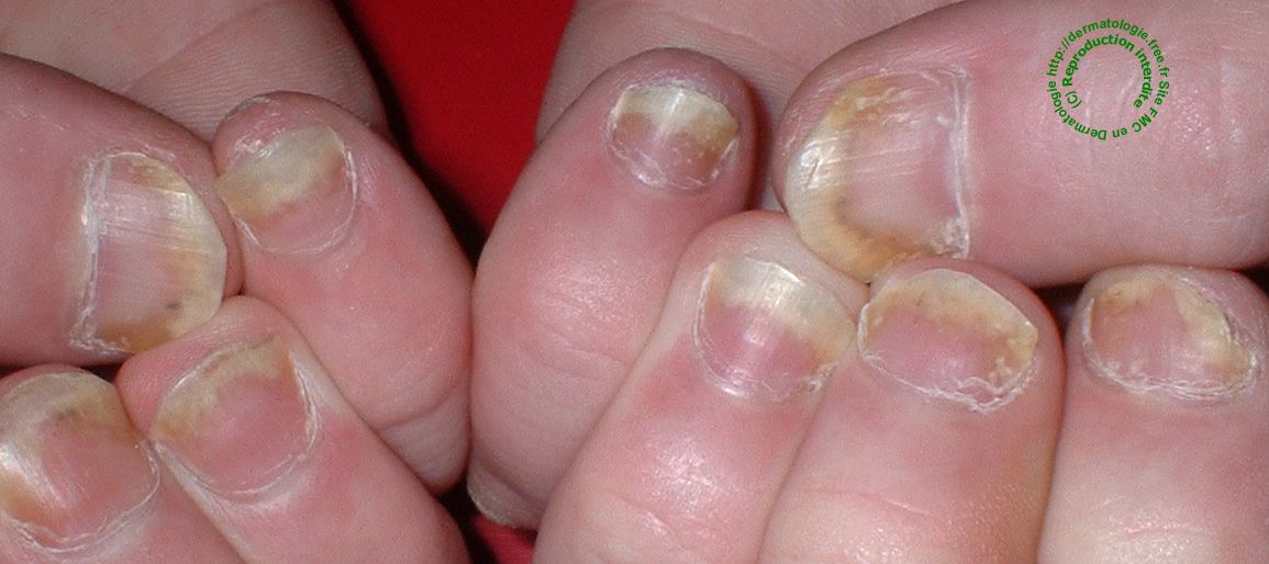 psoriasis unguéal