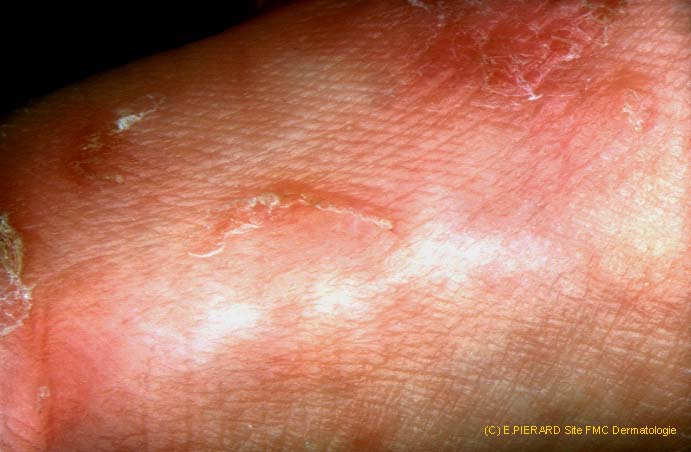 Ces photos ne sont pas visibles via le cache d'un moteur de recherche. Veuillez vous rendre sur le site dermatologie.free.fr pour les visulaliser.