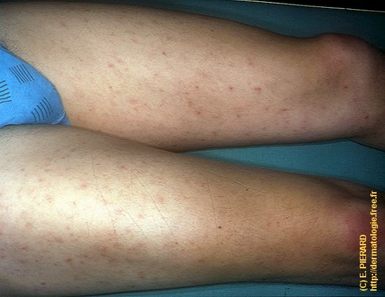 pityriasis lichenoides