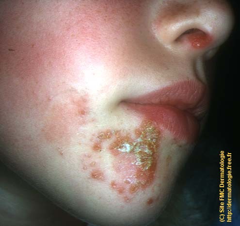 DERMATOLOGIE impetigo streptocoque staphylocoque bulle visage ...