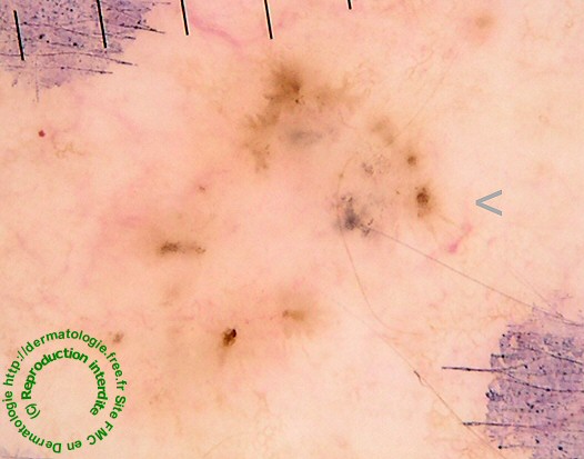 basal cell carcinoma carcinome basocellulaire dermatoscopie dermoscopie dermoscopy