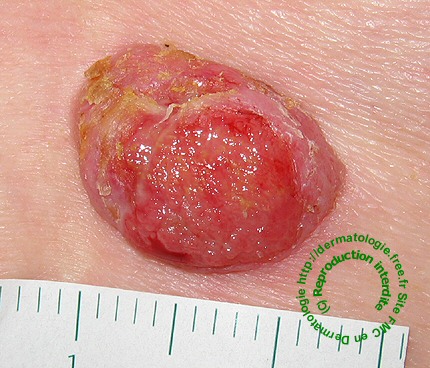 basal cell carcinoma carcinome basocellulaire dermatoscopie dermoscopie dermoscopy
