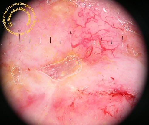 basal cell carcinoma carcinome basocellulaire dermatoscopie dermoscopie dermoscopy