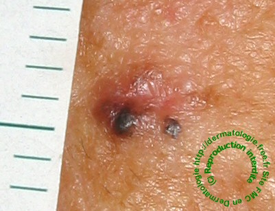 carcinome basocellulaire