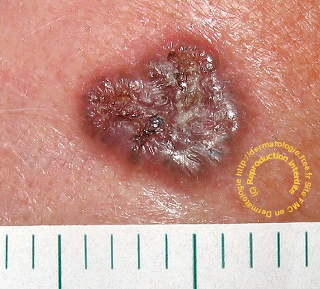 carcinome baso-cellulaire nodulaire