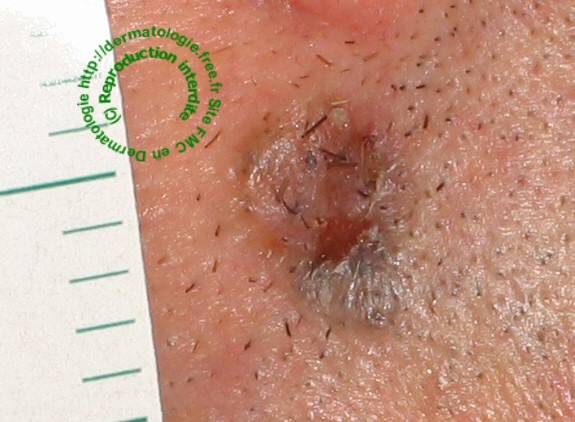 carcinome basocellulaire