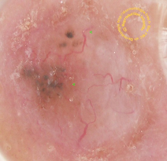 carcinome basocellulaire