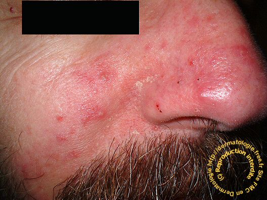 DERMATOLOGIE rosacée rosacea pustules visage face joues ...