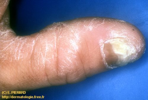 Photo n°1 : psoriasis unguéal